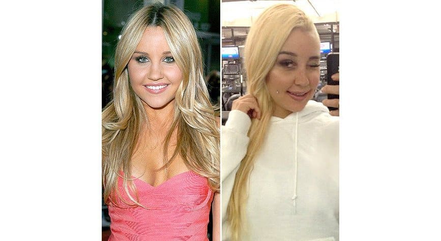20 Worst Cases Of Celebrity Plastic Surgery Gone Wrong Page 3 Of 5
