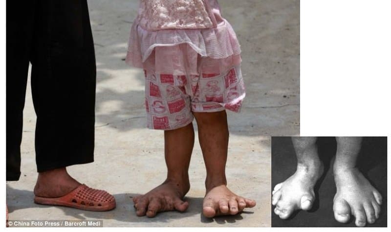20 Of The Weirdest And Rarest Diseases Known To Mankind