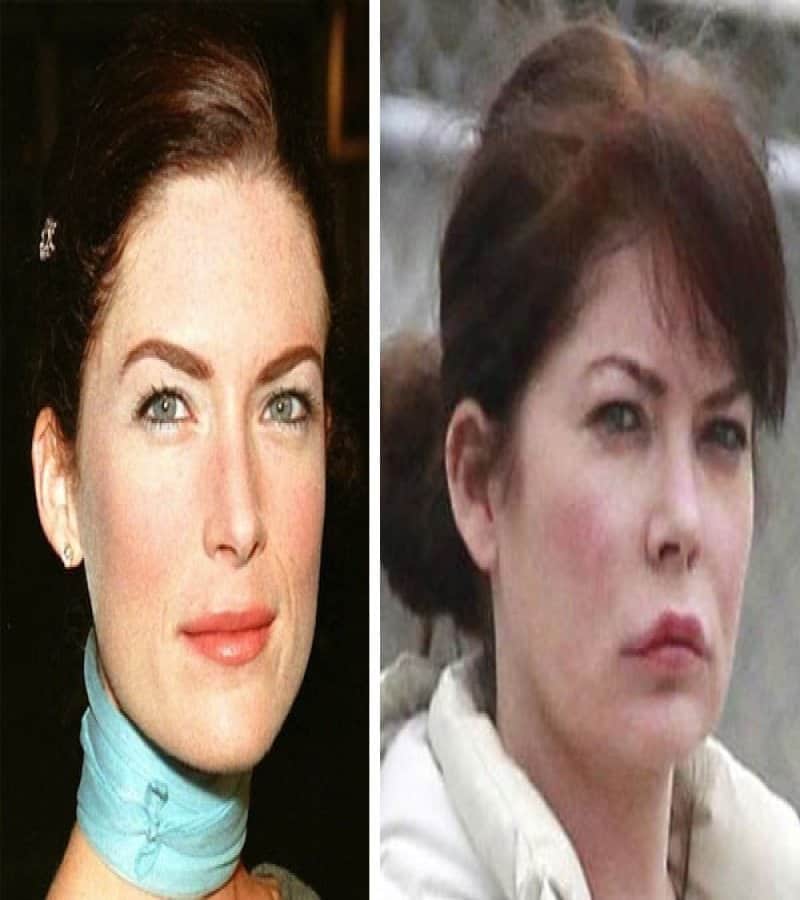 20 Of The Worst Celebrity Plastic Surgery Disasters